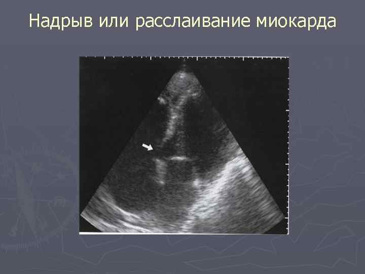 Надрыв или расслаивание миокарда 