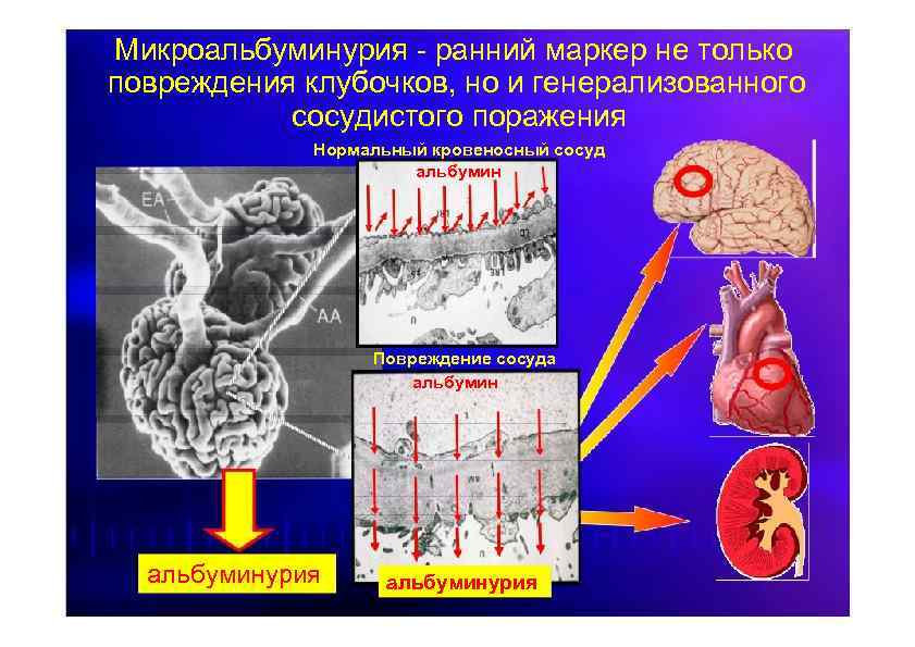 Микроальбуминурия - ранний маркер не только повреждения клубочков, но и генерализованного сосудистого поражения Нормальный