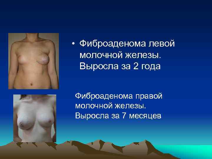  • Фиброаденома левой молочной железы. Выросла за 2 года Фиброаденома правой молочной железы.