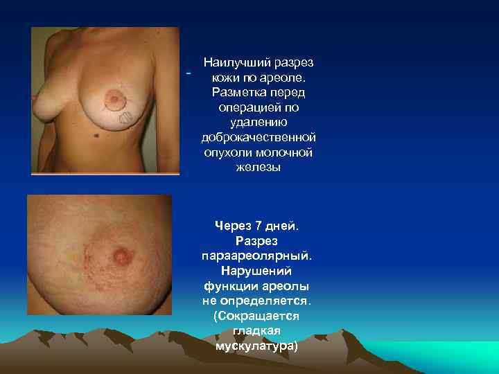  Наилучший разрез кожи по ареоле. Разметка перед операцией по удалению доброкачественной опухоли молочной