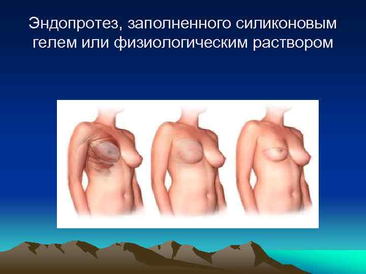 Эндопротез, заполненного силиконовым гелем или физиологическим раствором 