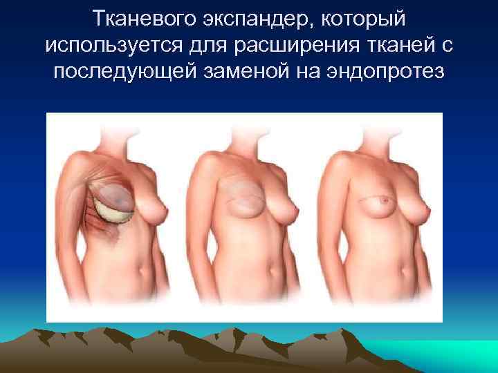 Тканевого экспандер, который используется для расширения тканей с последующей заменой на эндопротез 