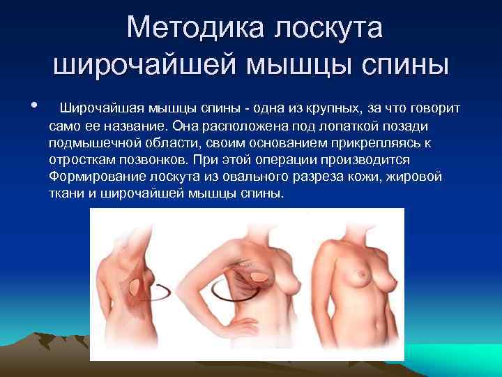  Методика лоскута широчайшей мышцы спины • Широчайшая мышцы спины одна из крупных, за