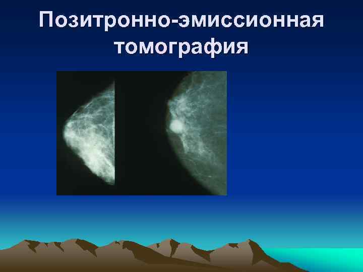 Позитронно-эмиссионная томография 