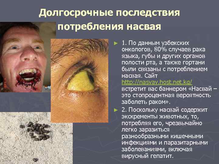 Долгосрочные последствия потребления насвая 1. По данным узбекских онкологов, 80% случаев рака языка, губы