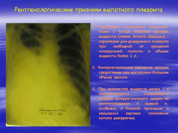 Для клинической картины плеврита характерно все кроме тест