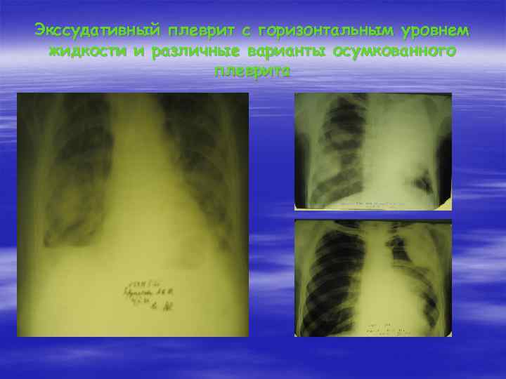 Экссудативный плеврит с горизонтальным уровнем жидкости и различные варианты осумкованного плеврита 