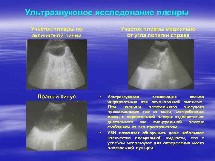 Узи плевральной полости. УЗИ плевральных полостей методика. УЗИ плевральных синусов. УЗИ плевральной полости легких. Плевральный выпот на УЗИ.