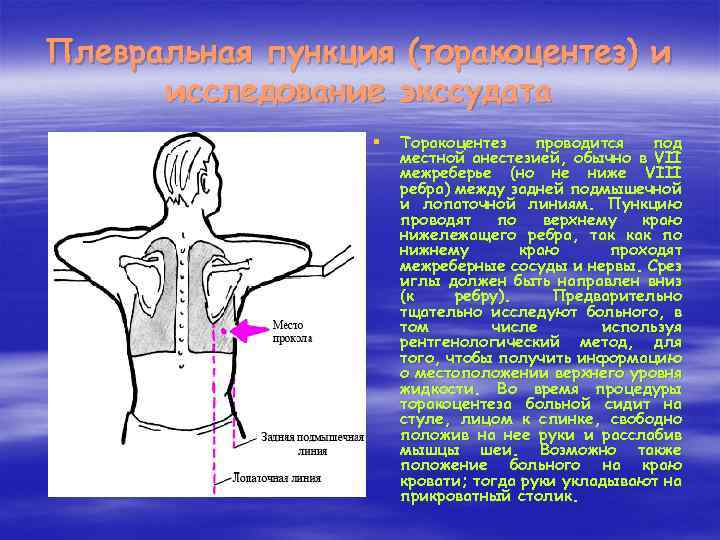 Плевральная пункция (торакоцентез) и исследование экссудата § Торакоцентез проводится под местной анестезией, обычно в