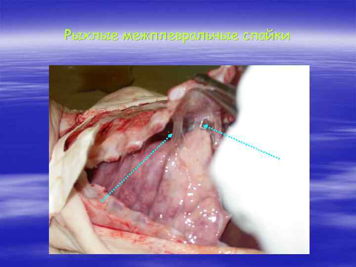 Рыхлые межплевральные спайки 