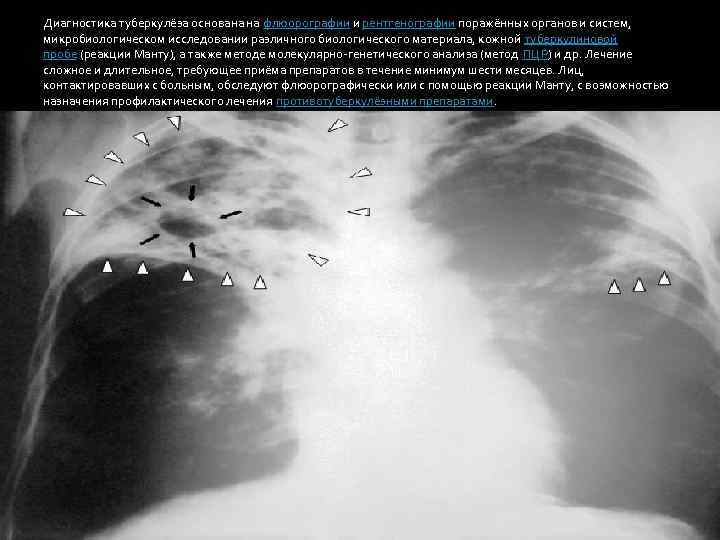 Диагностика туберкулёза основана на флюорографии и рентгенографии поражённых органов и систем, микробиологическом исследовании различного
