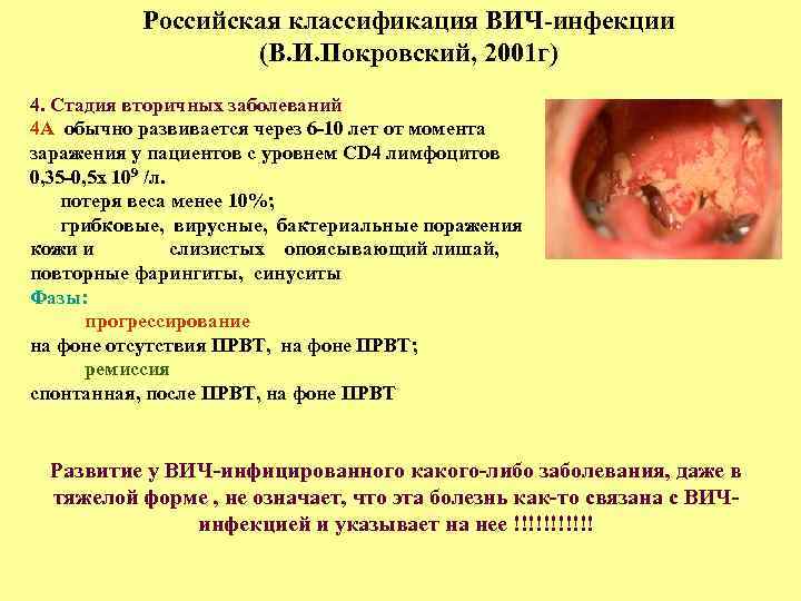 Российская классификация ВИЧ-инфекции (В. И. Покровский, 2001 г) 4. Стадия вторичных заболеваний 4 А