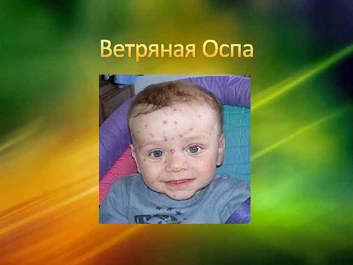  Ветряная Оспа 
