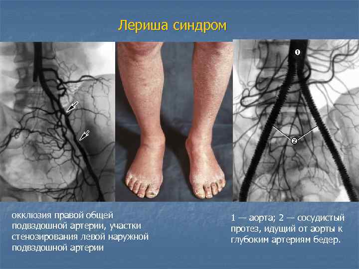  Лериша синдром окклюзия правой общей подвздошной артерии, участки стенозирования левой наружной подвздошной артерии
