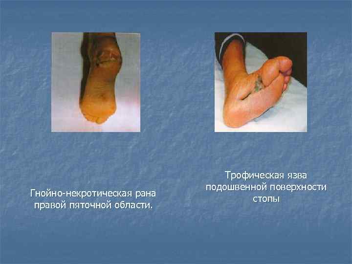  Гнойно некротическая рана правой пяточной области. Трофическая язва подошвенной поверхности стопы 