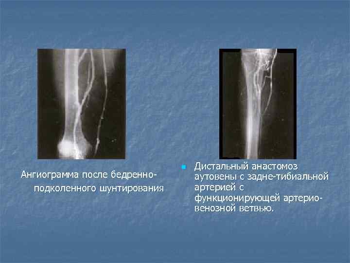 Ангиограмма после бедренно подколенного шунтирования n Дистальный анастомоз аутовены с задне тибиальной артерией с