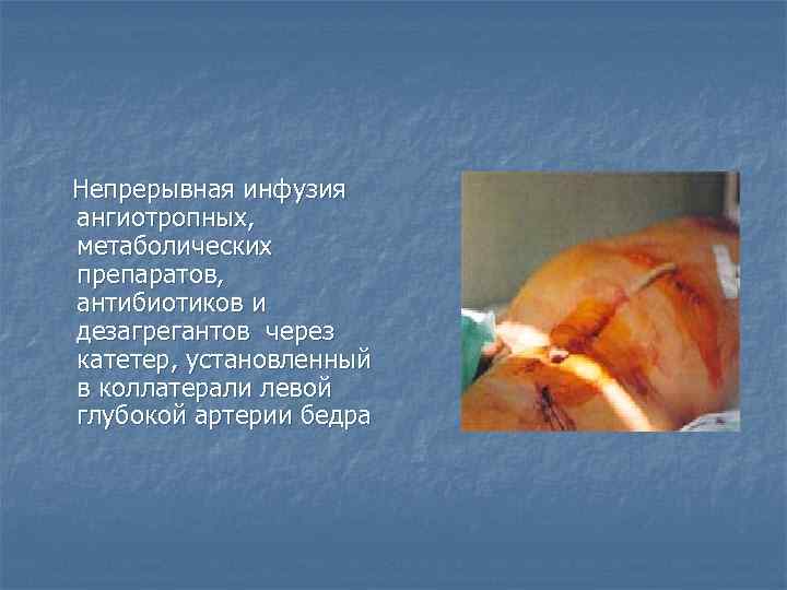  Непрерывная инфузия ангиотропных, метаболических препаратов, антибиотиков и дезагрегантов через катетер, установленный в коллатерали