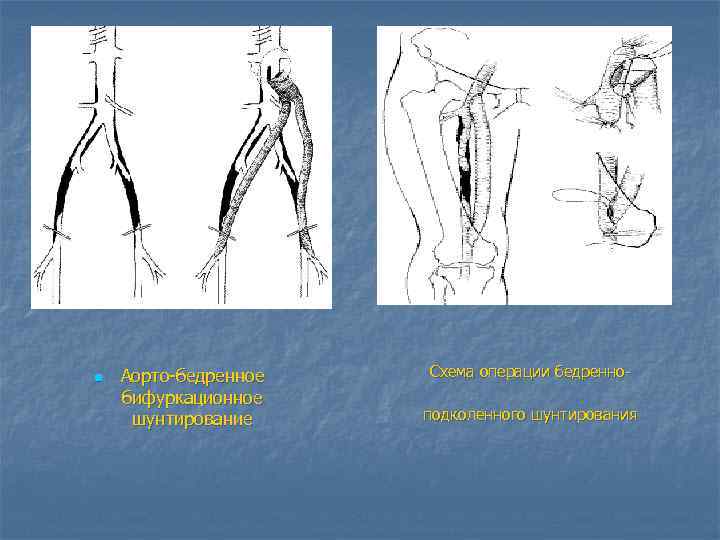 n Аорто бедренное бифуркационное шунтирование Схема операции бедренно подколенного шунтирования 