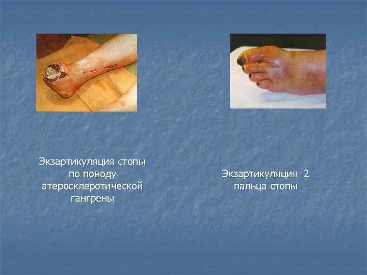 Экзартикуляция стопы по поводу атеросклеротической гангрены Экзартикуляция 2 пальца стопы 