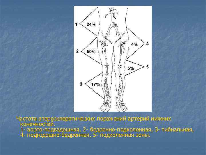  Частота атеросклеротических поражений артерий нижних конечностей. 1 аорто подвздошная, 2 бедренно подколенная, 3