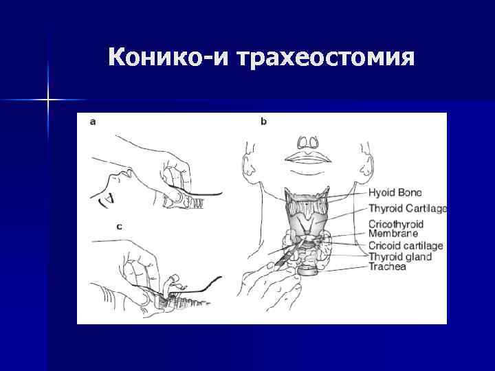 Конико-и трахеостомия 