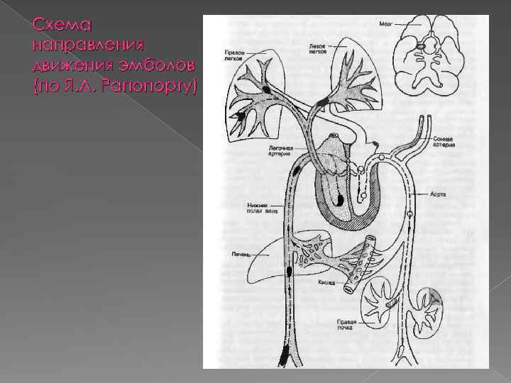 Схема направления движения эмболов (по Я. Л. Рапопорту) 