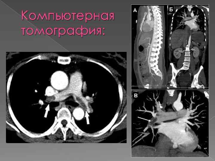 Компьютерная томография: 