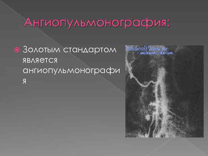 Ангиопульмонография: Золотым стандартом является ангиопульмонографи я 