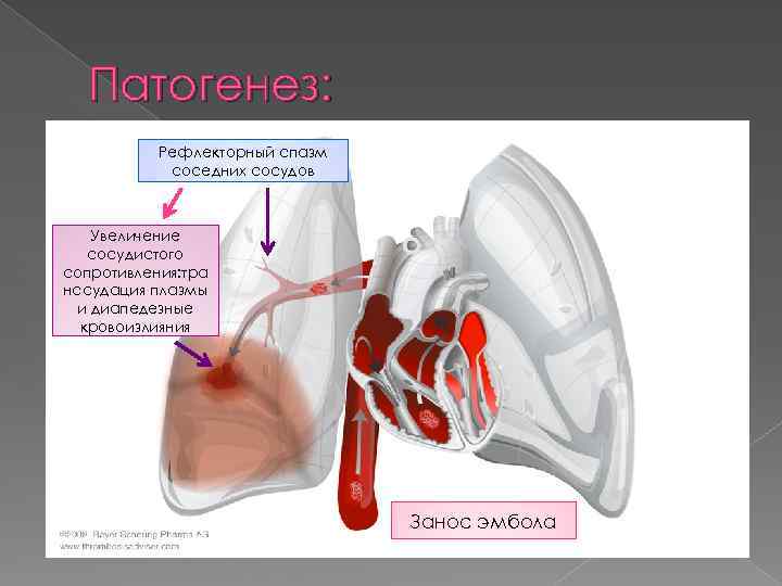 Патогенез: Рефлекторный спазм соседних сосудов Увеличение сосудистого сопротивления: тра нссудация плазмы и диапедезные кровоизлияния