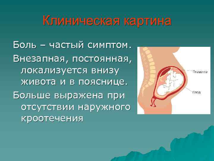 Клиническая картина Боль – частый симптом. Внезапная, постоянная, локализуется внизу живота и в пояснице.