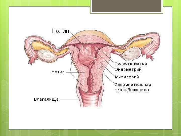 Полипы в матке причины. Плацентарный полип в матке.