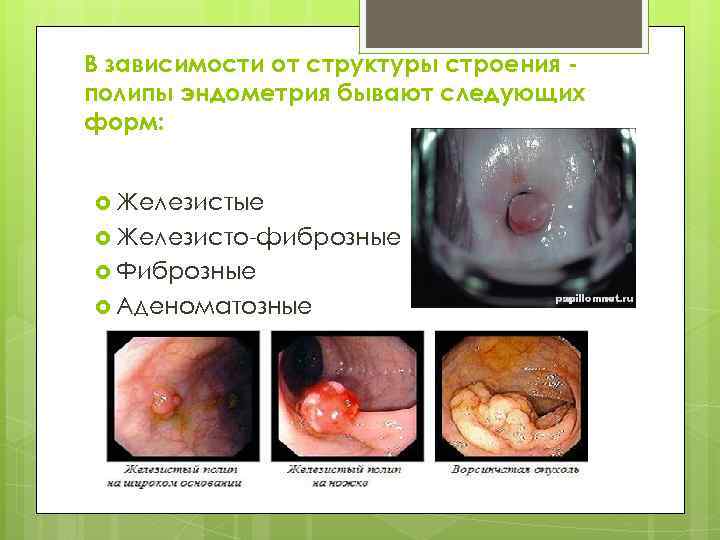 В зависимости от структуры строения полипы эндометрия бывают следующих форм: Железистые Железисто-фиброзные Фиброзные Аденоматозные