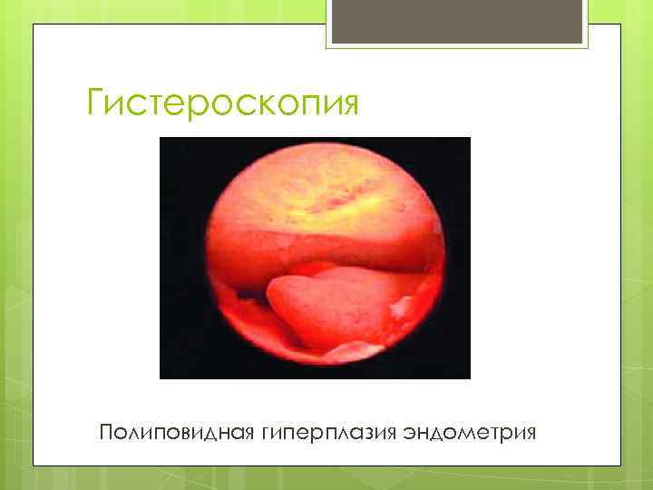 Гистероскопия Полиповидная гиперплазия эндометрия 