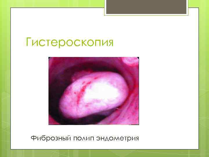 Гистероскопия Фиброзный полип эндометрия 