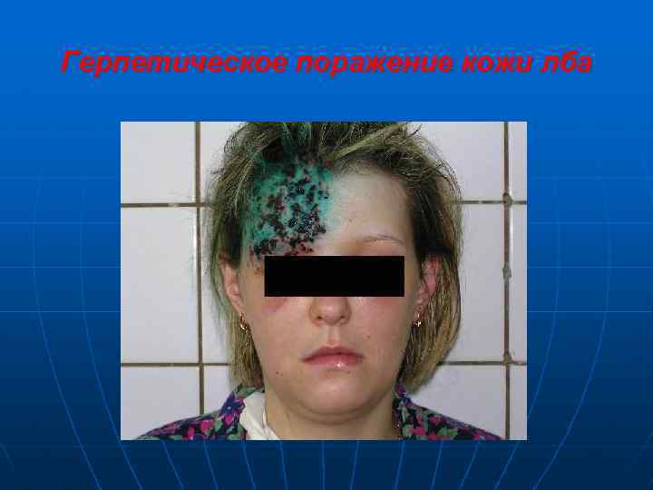 Герпетическое поражение кожи лба 