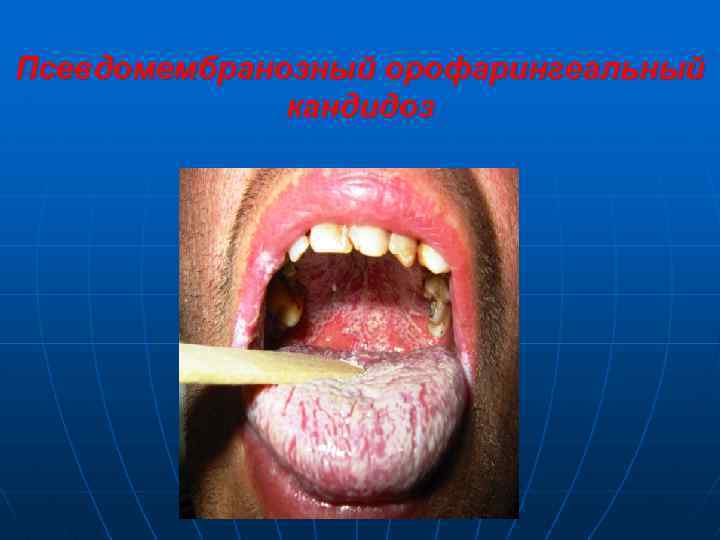 Псевдомембранозный орофарингеальный кандидоз 