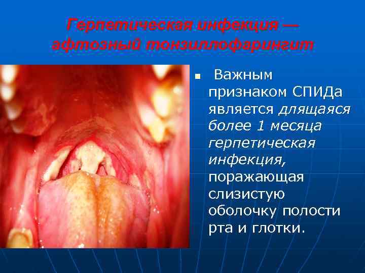 Герпетическая инфекция — афтозный тонзиллофарингит n Важным признаком СПИДа является длящаяся более 1 месяца