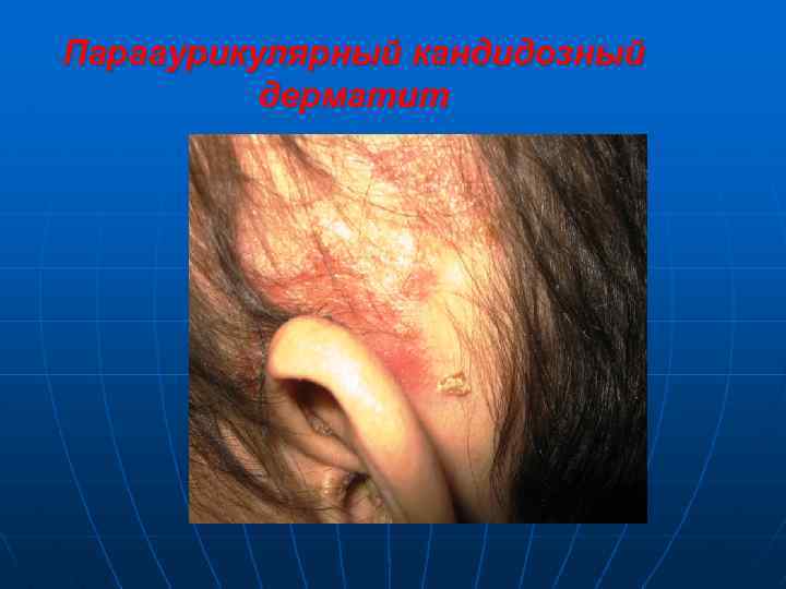Парааурикулярный кандидозный дерматит 