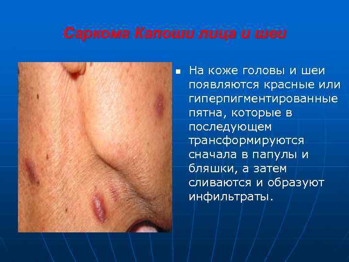 Саркома Капоши лица и шеи n На коже головы и шеи появляются красные или