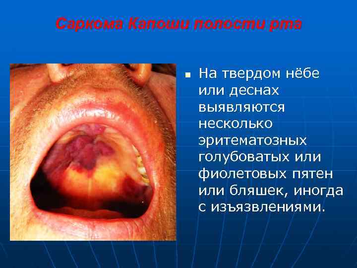 Саркома Капоши полости рта n На твердом нёбе или деснах выявляются несколько эритематозных голубоватых