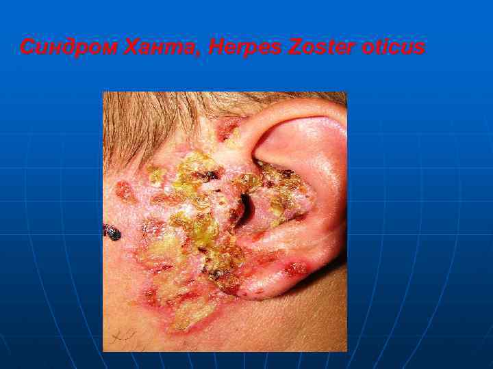 Синдром Ханта, Herpes Zoster oticus 