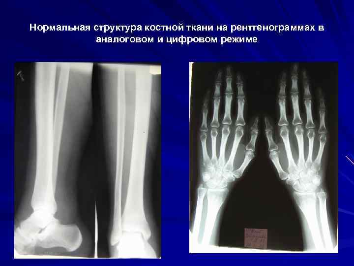 Нормальная структура костной ткани на рентгенограммах в аналоговом и цифровом режиме 