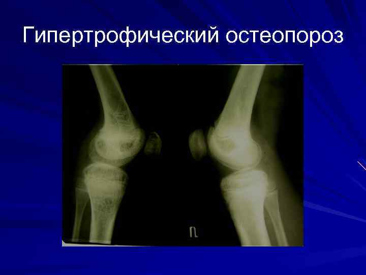 Гипертрофический остеопороз 