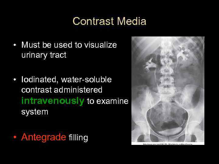 Contrast Media • Must be used to visualize urinary tract • Iodinated, water-soluble contrast