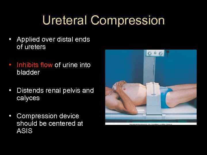 Ureteral Compression • Applied over distal ends of ureters • Inhibits flow of urine