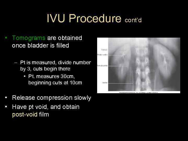 IVU Procedure cont’d • Tomograms are obtained once bladder is filled – Pt is