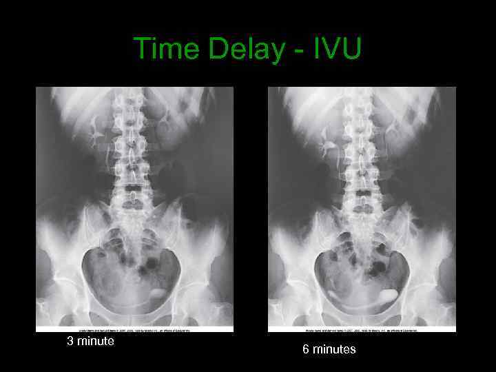 Time Delay - IVU 3 minute 6 minutes 