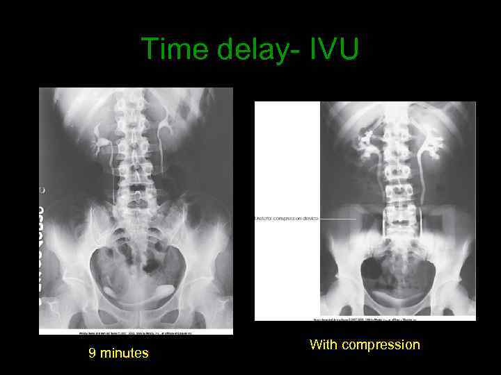 Time delay- IVU 9 minutes With compression 