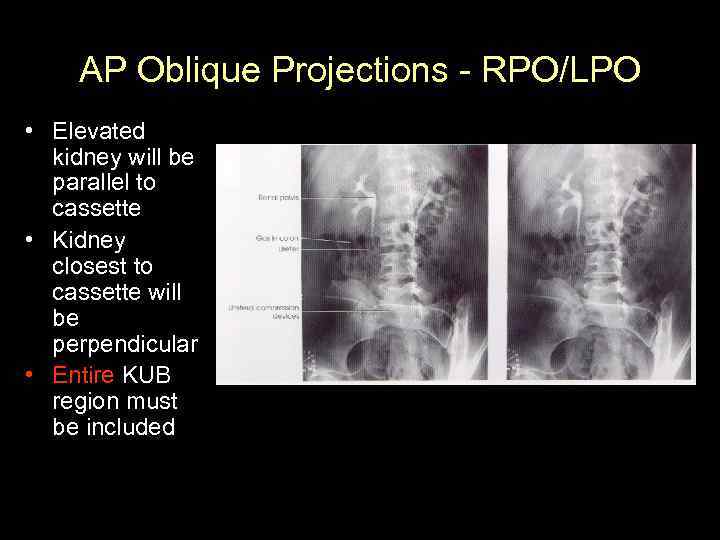 AP Oblique Projections - RPO/LPO • Elevated kidney will be parallel to cassette •