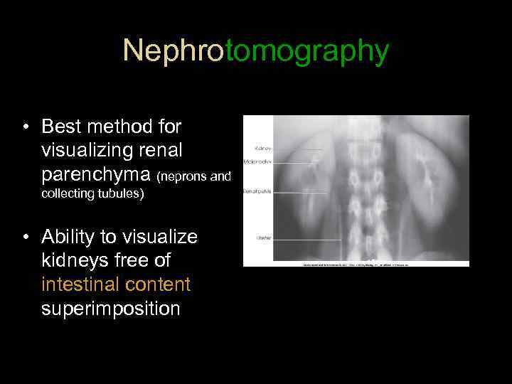 Nephrotomography • Best method for visualizing renal parenchyma (neprons and collecting tubules) • Ability